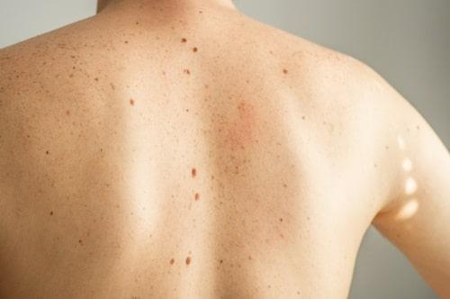 Body Acne Meaning (And How Exposed Clears It Naturally)