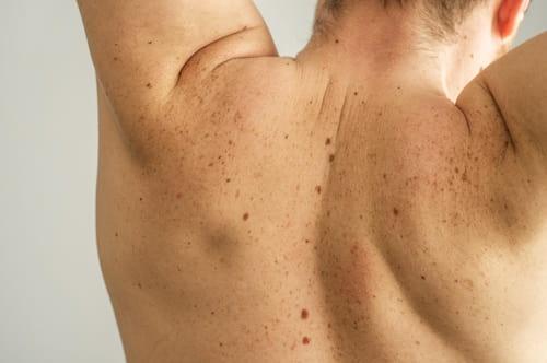 Best Chest Acne Treatment That Works Fast (Go With Exposed)