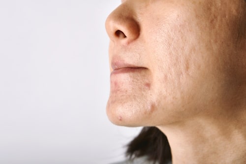Acne in 40s Female (Causes, Treatments, and More)
