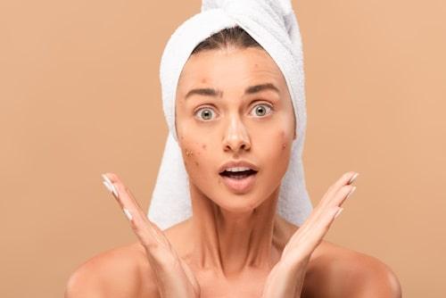 Why Am I Getting So Much Acne? (Exposed Solves It)