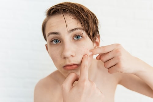 What Age Is Acne the Worst? (What You Need to Know)