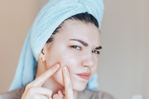 Popping Acne: Why You Should Avoid It