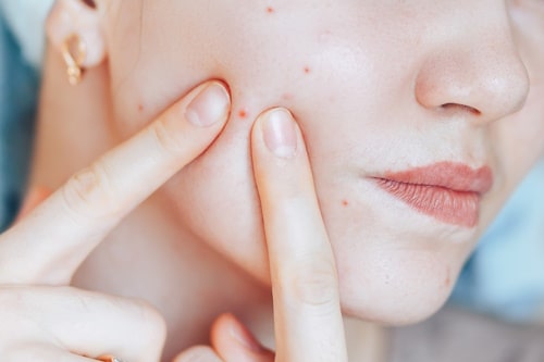 How Long Does It Take for Acne to Go Away?