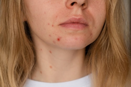 Why Won't My Acne Go Away? Causes and Remedies for Stubborn Acne