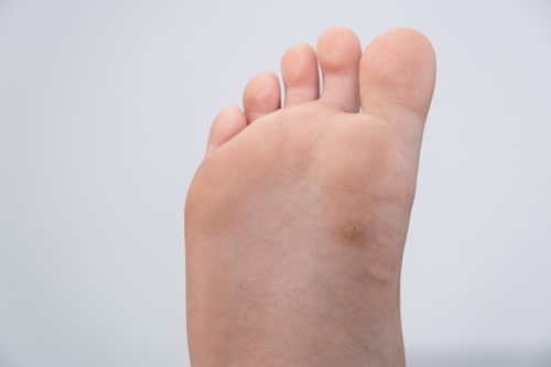 Acne on Feet (Causes, Treatments, and More)