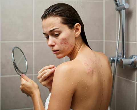 Why Is My Back Acne So Bad? (Exposed Clears It Fast)