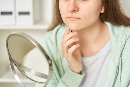 Best Treatment for Adult Acne? (8 Home Remedies You Need to Know)