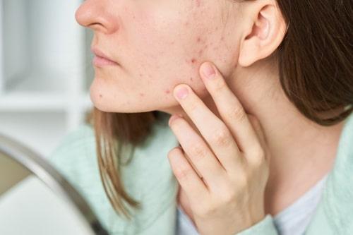 Why Is My Acne Getting Worse? (Exposed May Be The Fix)