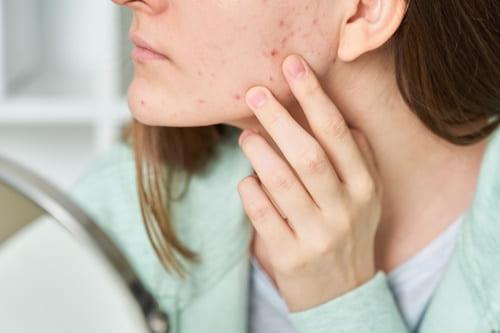 How To Make Acne Go Away Fast (Without Wrecking It—Exposed)