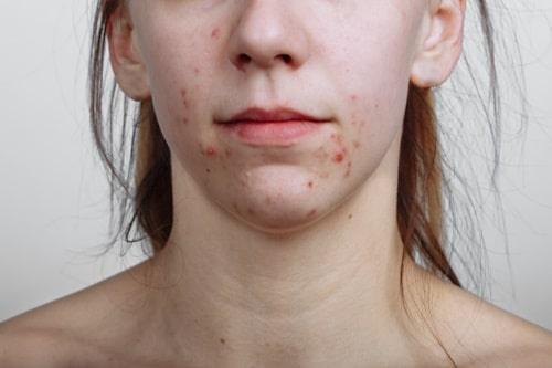 What Is Cluster Acne? (Causes, Treatments, and More)