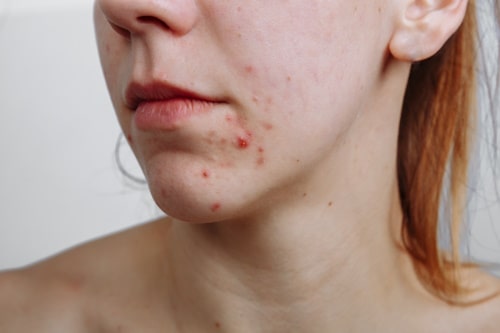 Bacterial Acne on Face? (Causes, Treatments, and More)