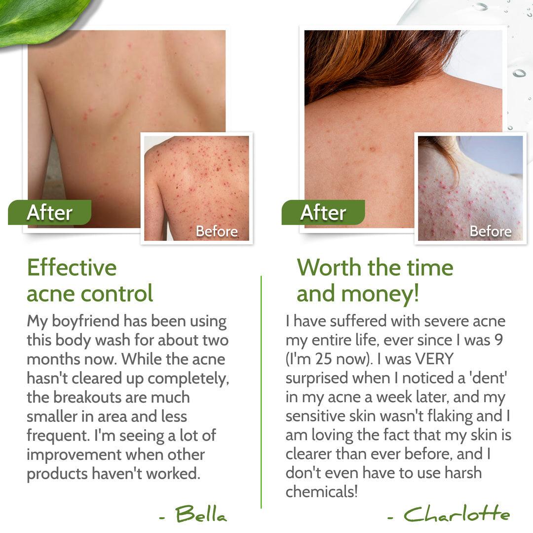 Body Acbe Body Acne Kit for back and body acne | Exposed Skin Care